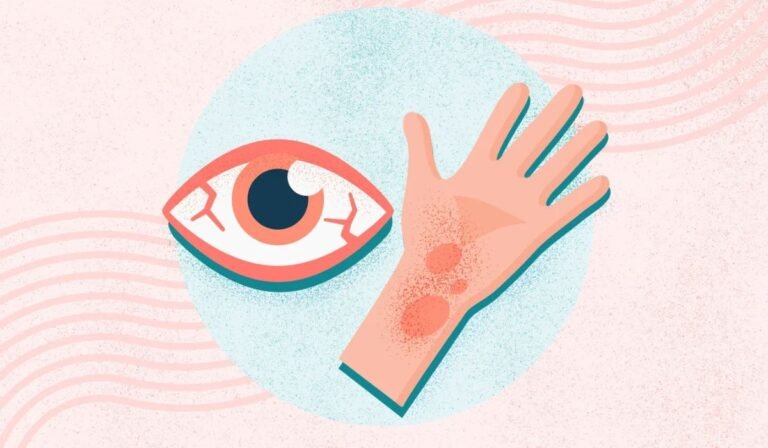 Common Allergy Triggers and Tips for Relief