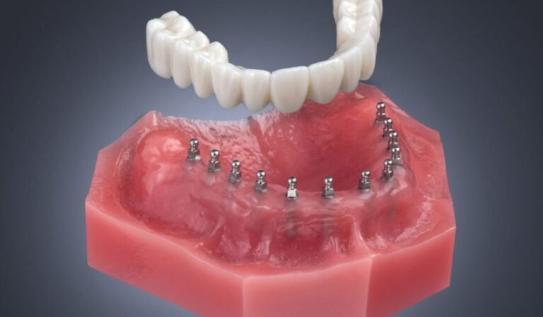 Modern Solutions to Full Mouth Tooth Loss