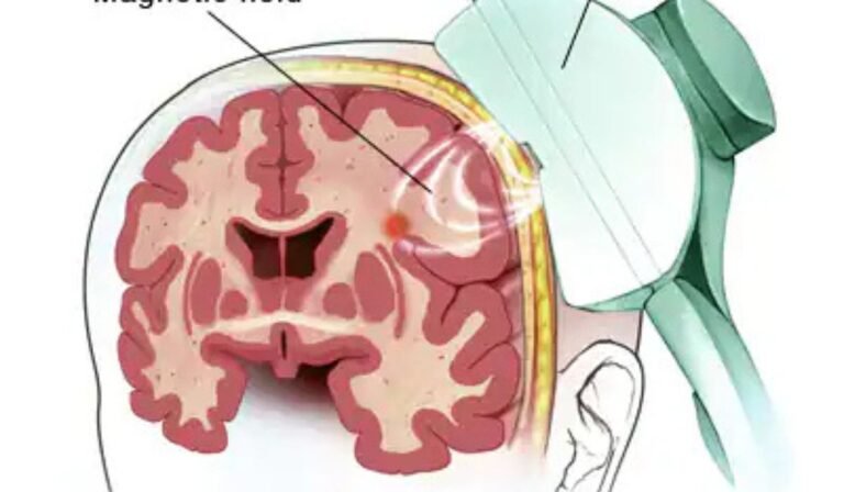The Science Behind Transcranial Magnetic Stimulation Therapy: How It Works