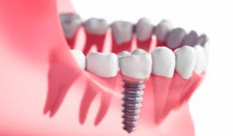 All You Need to Know About Getting a Complete Set of Dental Implants