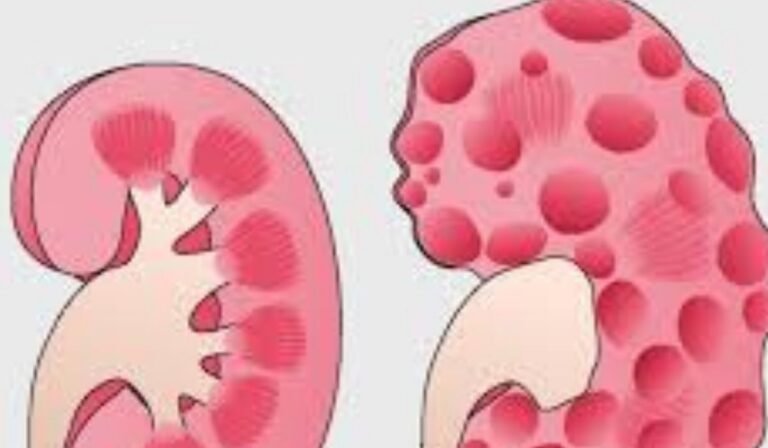 Living Well With Autosomal Dominant Polycystic Kidney Disease (ADPKD)
